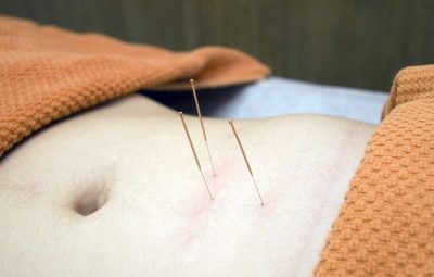 acupuncture